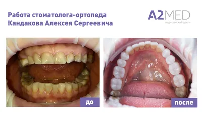 Виды зубных вкладок — Клиника \"Арбаль\" на Дмитрия Донского
