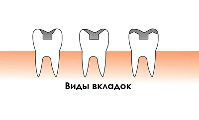 Зубные вкладки: цены, стоимость зубных вкладок под коронку в  Санкт-Петербурге