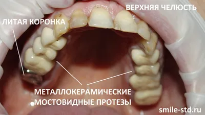 Выпала коронка с зуба - что делать | Причины выпадения и восстановление