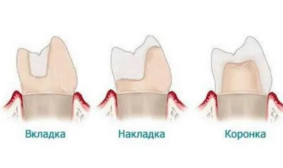 Металлокерамические коронки - цена в Москве | Клиника \"МАЙ\"