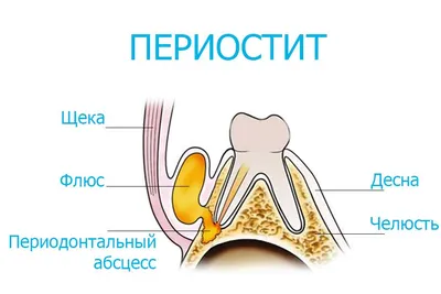 Лечение флюса (периостита): методы лечения, профилактика, цена в Москве