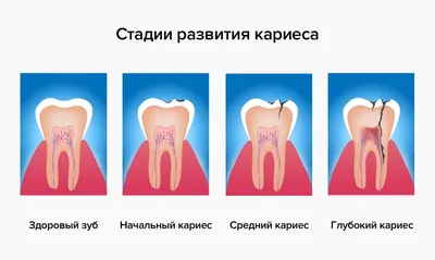 Флюс зуба — что это такое, как выглядит, чем лечить и чем опасен?