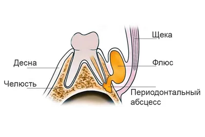 Как лечить флюс зуба - блог Dantistclinic