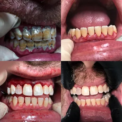 Ультразвуковая чистка зубов до и после фото — стоматология «Один к Одному»  на Войковской