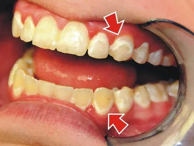 ARAY-Dent - До и после чистки. Зачем нужна профессиональная чистка зубов?  Даже при самой тщательной и старательной чистке зубов, со временем все  равно образуются зубные отложения, зубной камень. Вначале образуется мягкий  налет