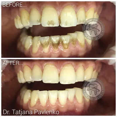 Профессиональная чистка зубов: фото до и после в Санкт-Петербурге