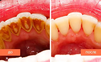 Удаление зубного камня с ультразвуком и Air Flow в эстетической  стоматологии. — Эстетическая стоматология Deva-Dent в Москве