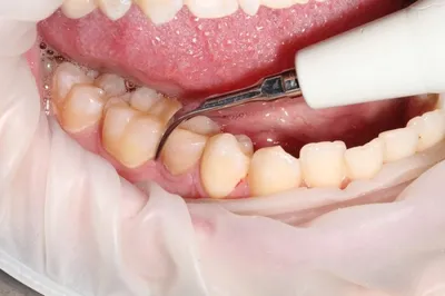 До и после. Профессиональная гигиена полости рта. Налет курильщика. |  Советы стоматолога | Дзен