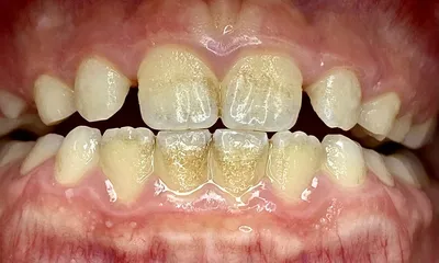 Зубной камень - удаление зубного камня и зубного налет с помощью процедуры  био гигиены. - YouTube
