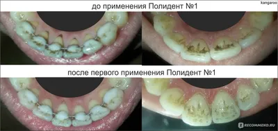 Удаление зубного камня [цены, методы, рекомендации после]