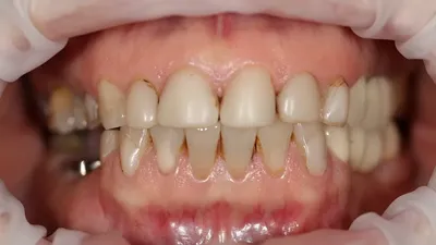Чистка зубов в Хабаровске | Гигиена полости рта в стоматологии