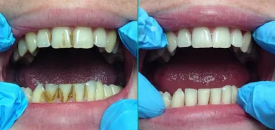 Удаление зубного камня в ТОП1 стоматологии Москвы - Немецкий  имплантологический центр