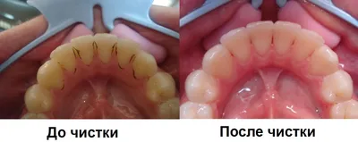 Особенности ультразвуковой чистки зубов - Стоматология Май