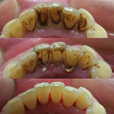 Чистка зубов цена у стоматолога | Профессиональная чистка лазером,  ультразвуком от налета