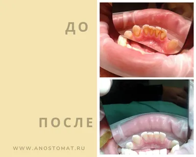 Чистка зубов Air Flow в Москве: цены, фото до и после, отзывы | Стоимость  чистки зубов Air Flow в клинике Seline