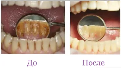 Зубной налет и зубной камень - механизм образования, виды, чем опасен, как  избавиться