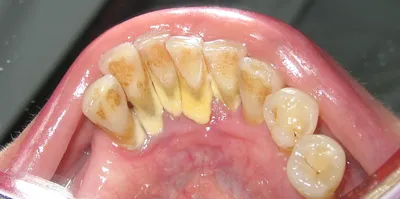 Зубной камень: причины и профилактика образования