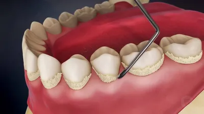 Чистка от зубного камня и налёта в Химках в стоматологической клинике  Специалист