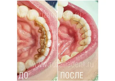 Удаление зубного камня - DENTALMAGAZINE.RU
