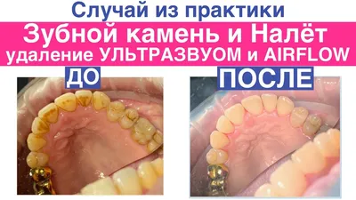 Профессиональная чистка зубов: фото до и после в Санкт-Петербурге