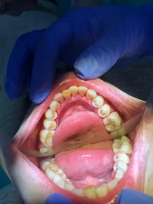 Удаление зубного камня, темного зубного налета ультразвуком и AirFlow.  Гигиена полости рта - YouTube