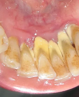 Зубной камень: причины образования и методы удаления – Стоматология МКС