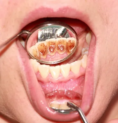 Детская стоматология Москва - До/После Вот что происходит с зубами, если их  не чистить☝🏻 👀 На верхних зубах образовался зубной налет, который  постепенно начал превращаться в камень. Налет скапливается, наслаивается, а  минералы,
