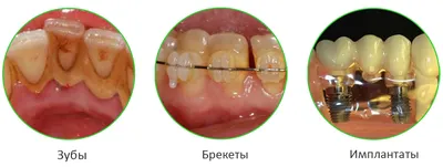 Как удалить зубной камень в домашних условиях: проверенные способы и  средства