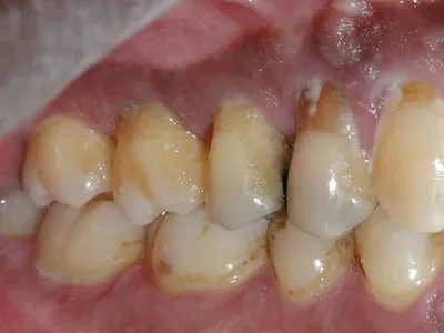 Профессиональная чистка зубов: цена и методы гигиенической чистки в  стоматологии — ROOTT