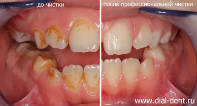 Темный налет на зубах у ребенка при аутоиммунном заболевании