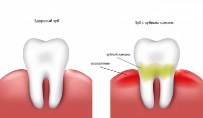 Зубной камень: 7 основных причин его формирования, 3 метода лечения