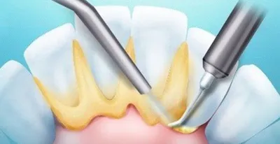 Удаление (чистка) зубного камня в Минске, цена | Снять зубной камень