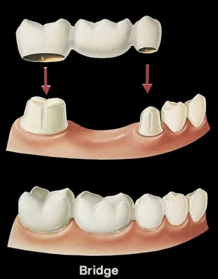 Имплант Или Мост Что Лучше Выбрать ЛюмиДент Поставить Зубы