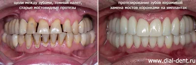 Коронки на зубах занизили прикус и разрушили другие зубы – клиника Smile  STD, Москва