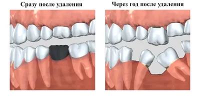 Металлокерамические мостовидные протезы, плюсы и минусы