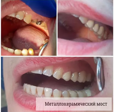 Коронки на зубах занизили прикус и разрушили другие зубы – клиника Smile  STD, Москва