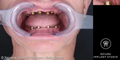 Мостовидное протезирование зубов в Запорожье | Dental Studio