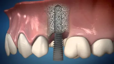 Как устанавливают импланты зубов – этапы установки импланта зуба