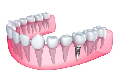 Виды зубных имплантов MIS и AlphaBio
