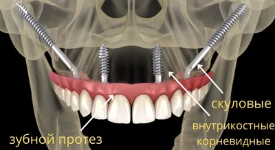ЗУБНЫЕ ИМПЛАНТАНТЫ - КАКИЕ ЛУЧШЕ и ЦЕНЫ ДОСТУПНЕЕ - Стоматология  АристократЪ-Дент