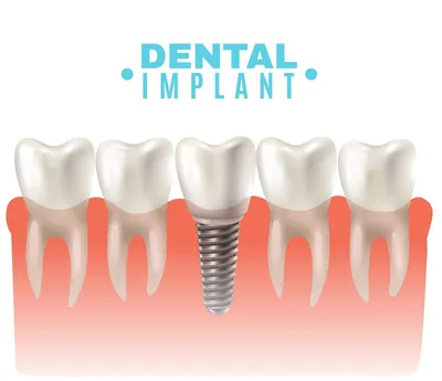 Имплантация зубов: лучшие зубные импланты и цены операции в Самаре