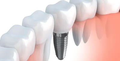 Имплантация зубов в Киеве – Стоимость и отзывы ᐈ Certus | Certus