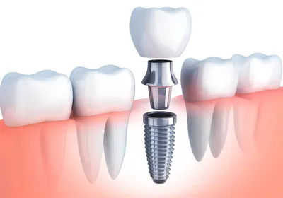 Что такое зубной имплант? Строение, состав, особенности