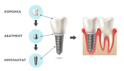 Зубные имплантаты - Вита Дент | Стоматологическая клиника