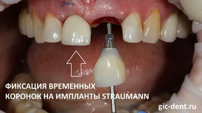 Установка зубных имплантов в стоматологической клинике в Москве –  стоматологическая клиника «Имплант Лаб»