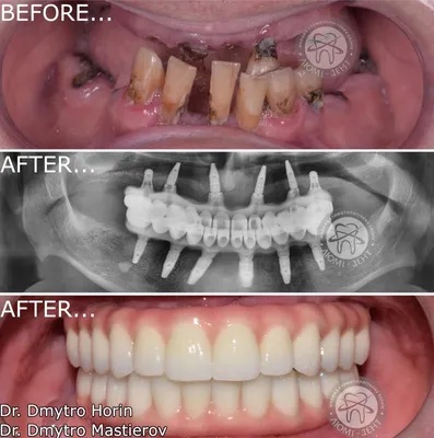 Мостовидный протез, зубной мост или имплант ⋆ Стоматология Оланко™