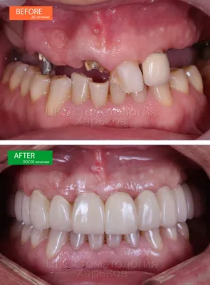 Условно-съёмное протезирование на имплантах, частичное или полное  несъёмного типа в стоматологии Ростова