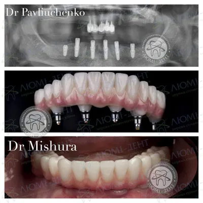 Восстановить все зубы при помощи имплантов. Стоимость тотального  протезирования зубов Харьков 2022