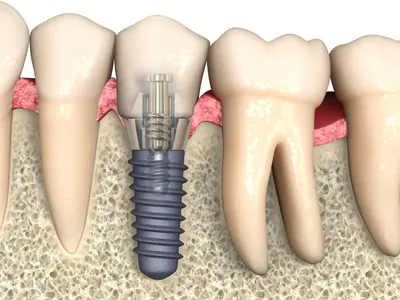 Какие зубные импланты считаются самыми надёжными? | Сеть стоматологических  клиник «Риадент» | Дзен