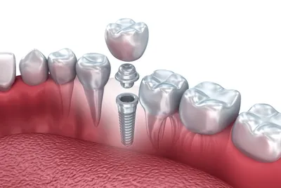 Зубной имплант или мостЧто лучше? - DentusDentino